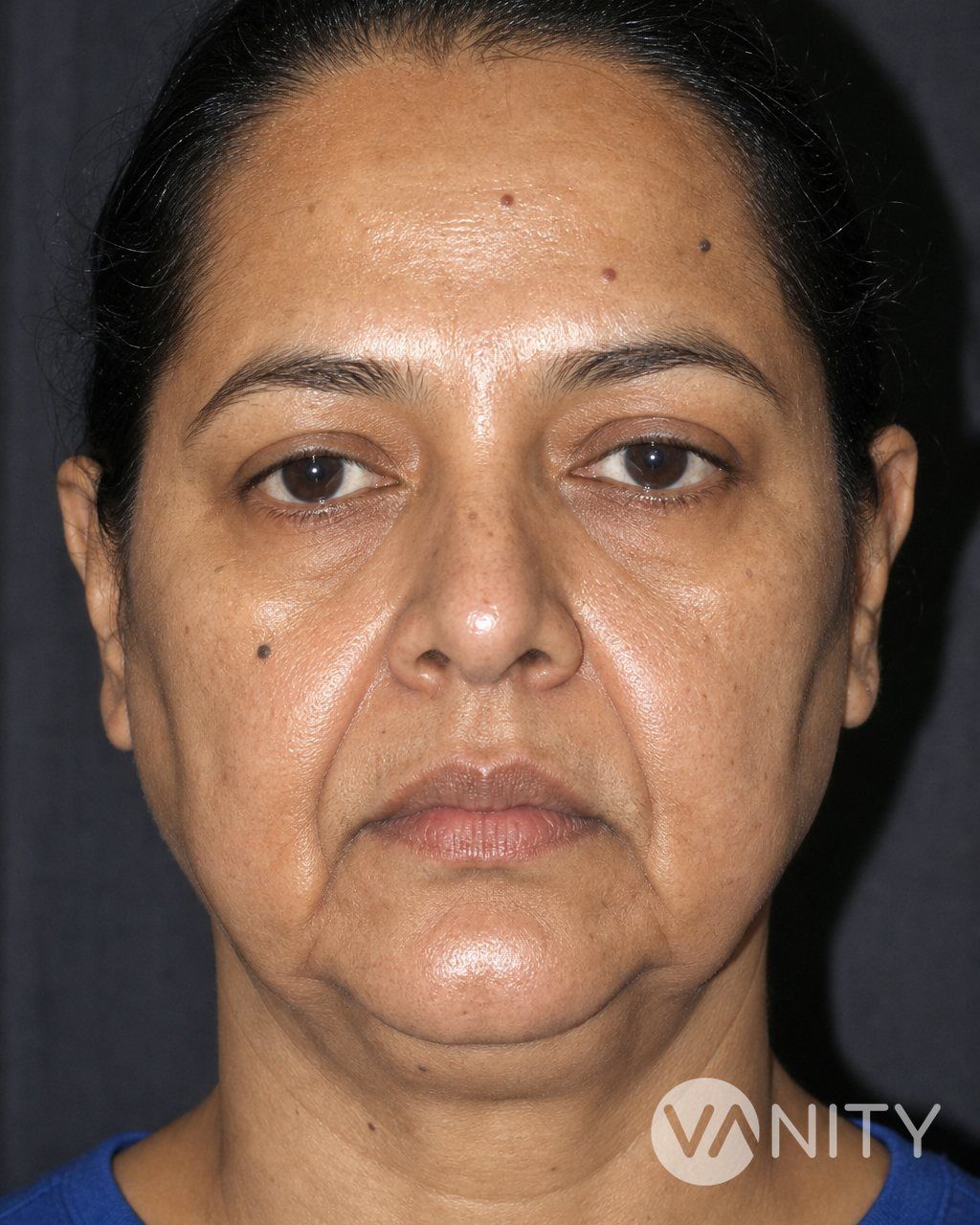 Before Face thread lift — illustrative, not a real patient