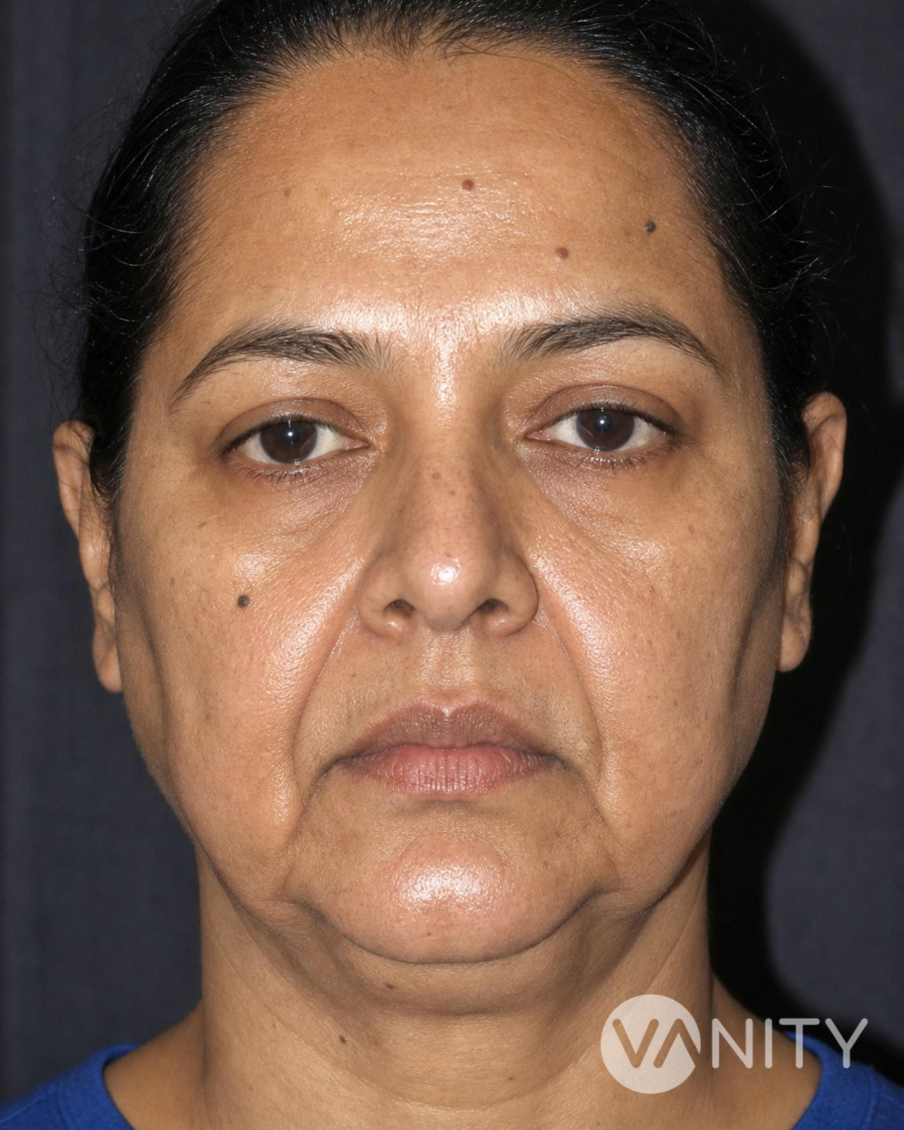 Before Face thread lift — illustrative, not a real patient