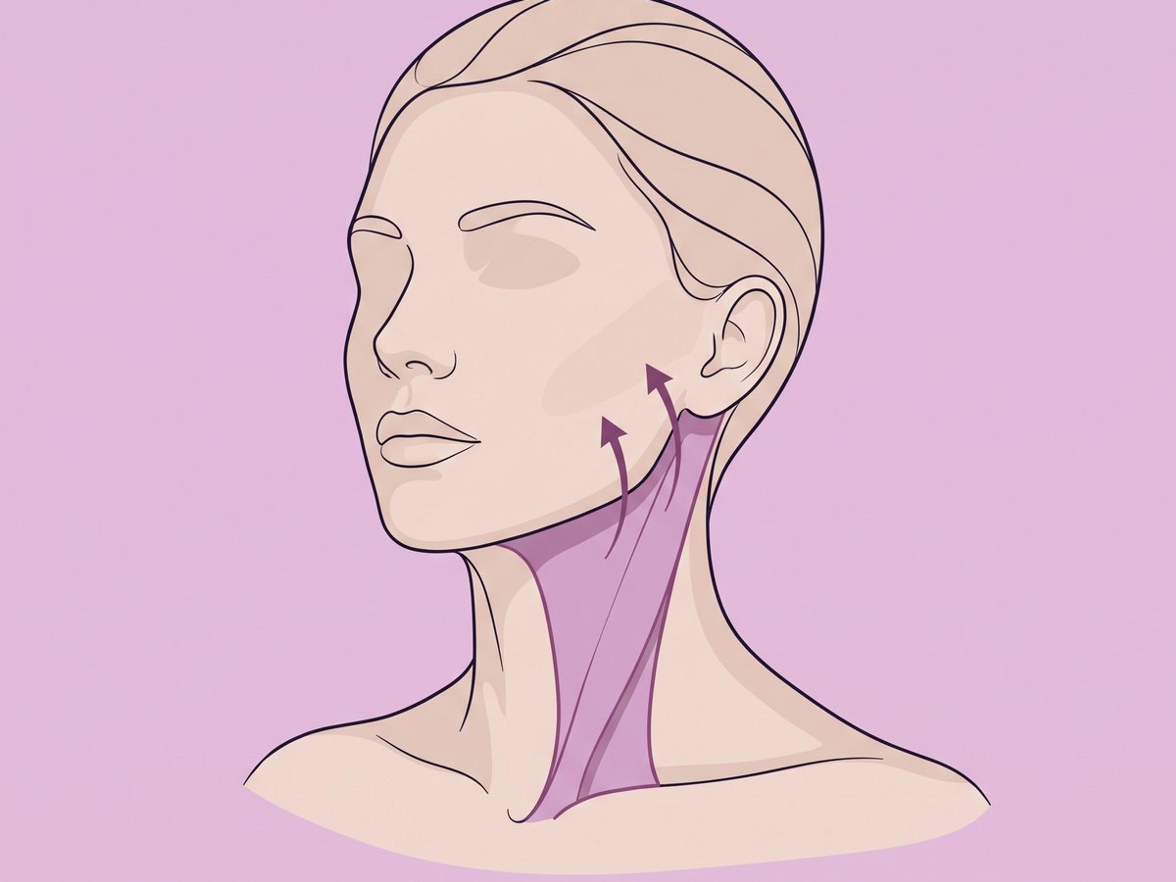 Laterale Platysmapexie — illustration