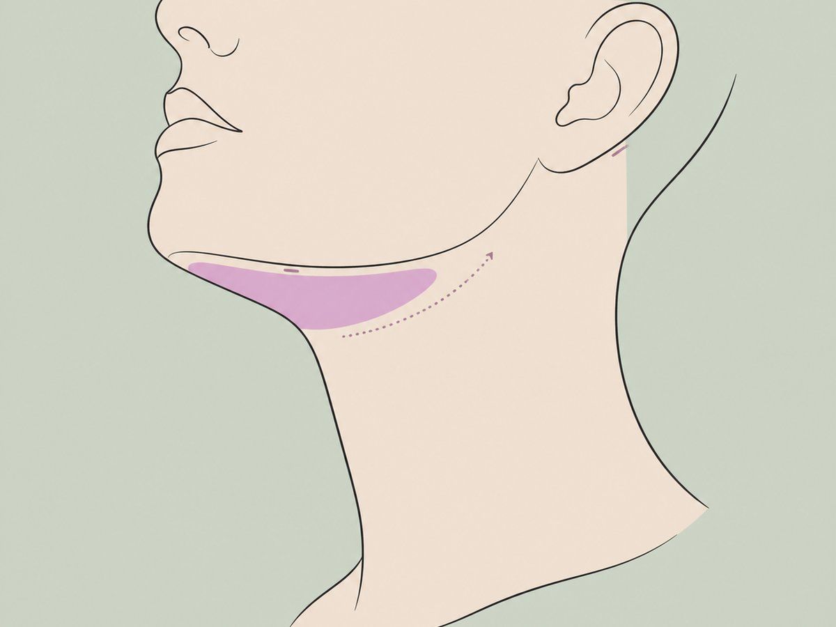 Fettabsaugung an Kinn und Hals — illustration