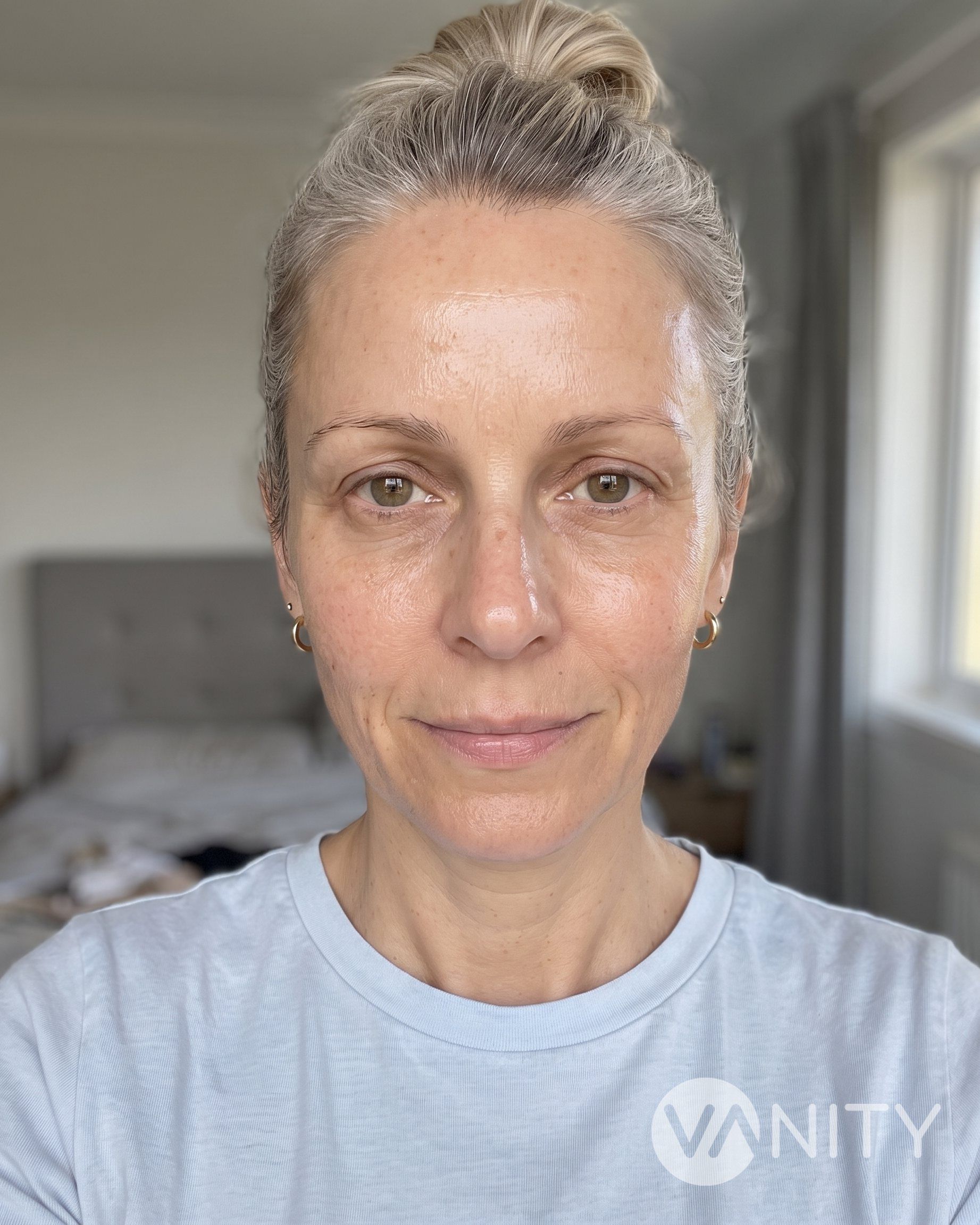 After Mesotherapy — illustrative, not a real patient