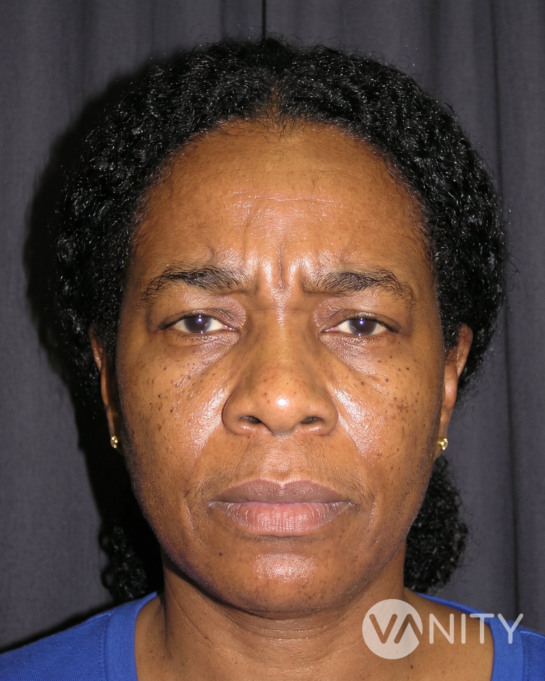 Before Brow lift — illustrative, not a real patient