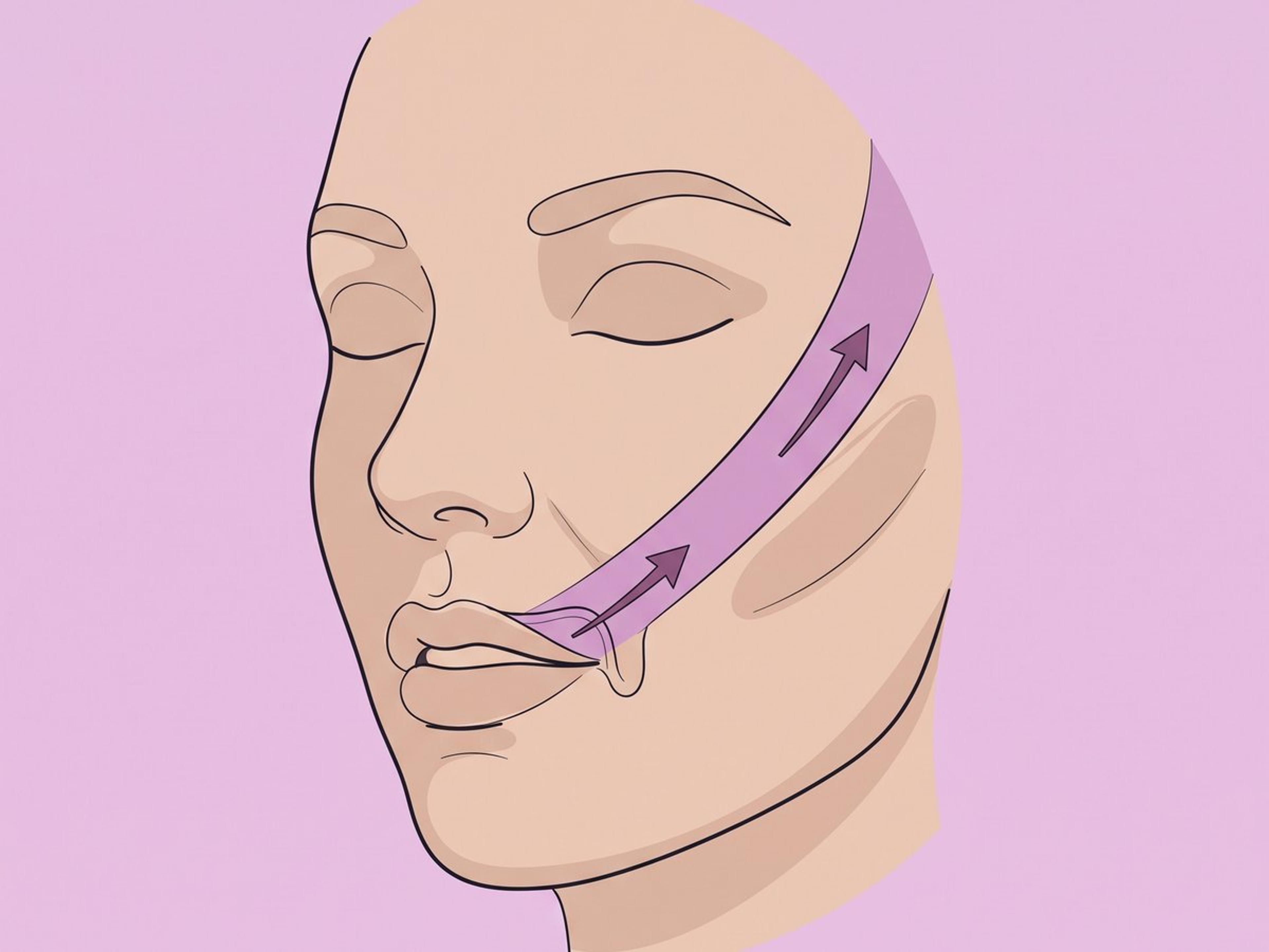 Intraorale Platzierung (gingivobukkal) — illustration