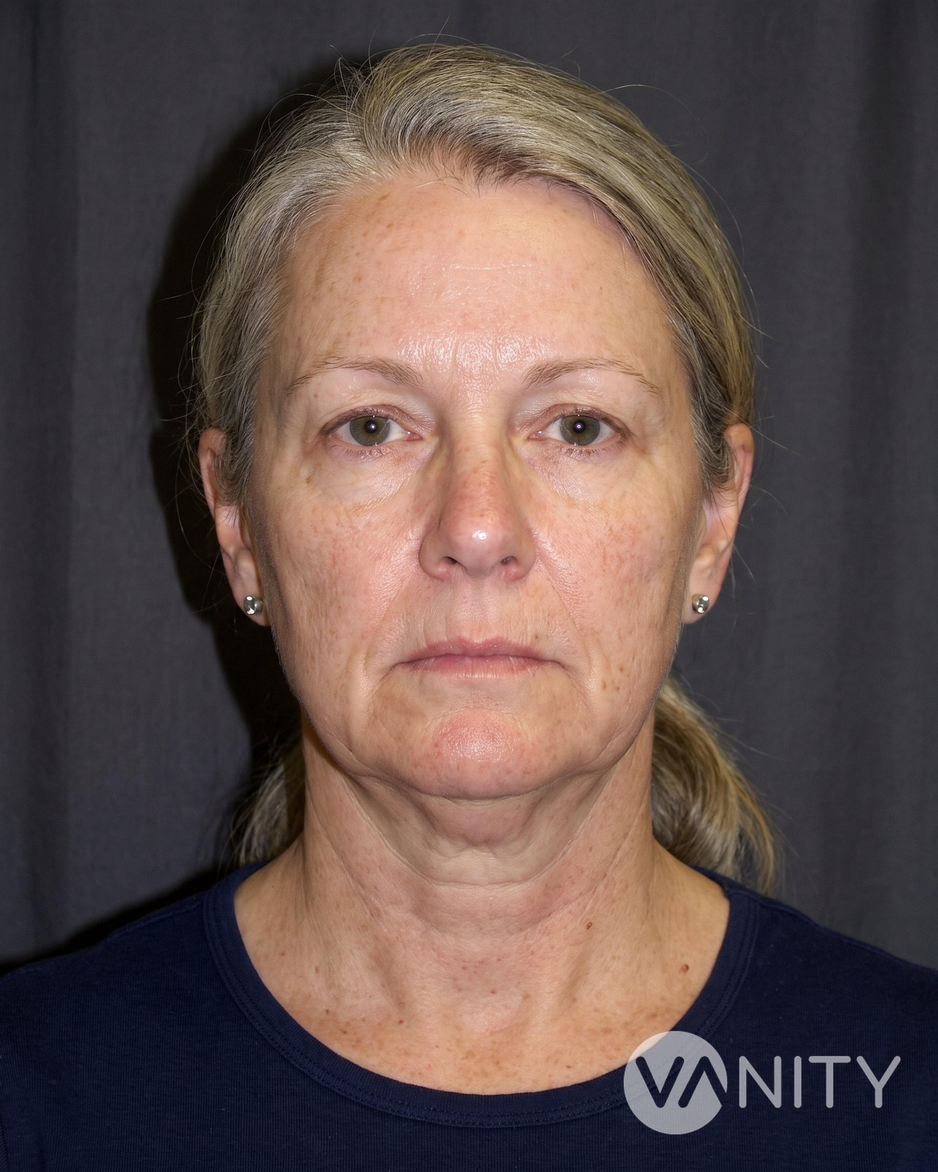 Before Facelift — illustrative, not a real patient