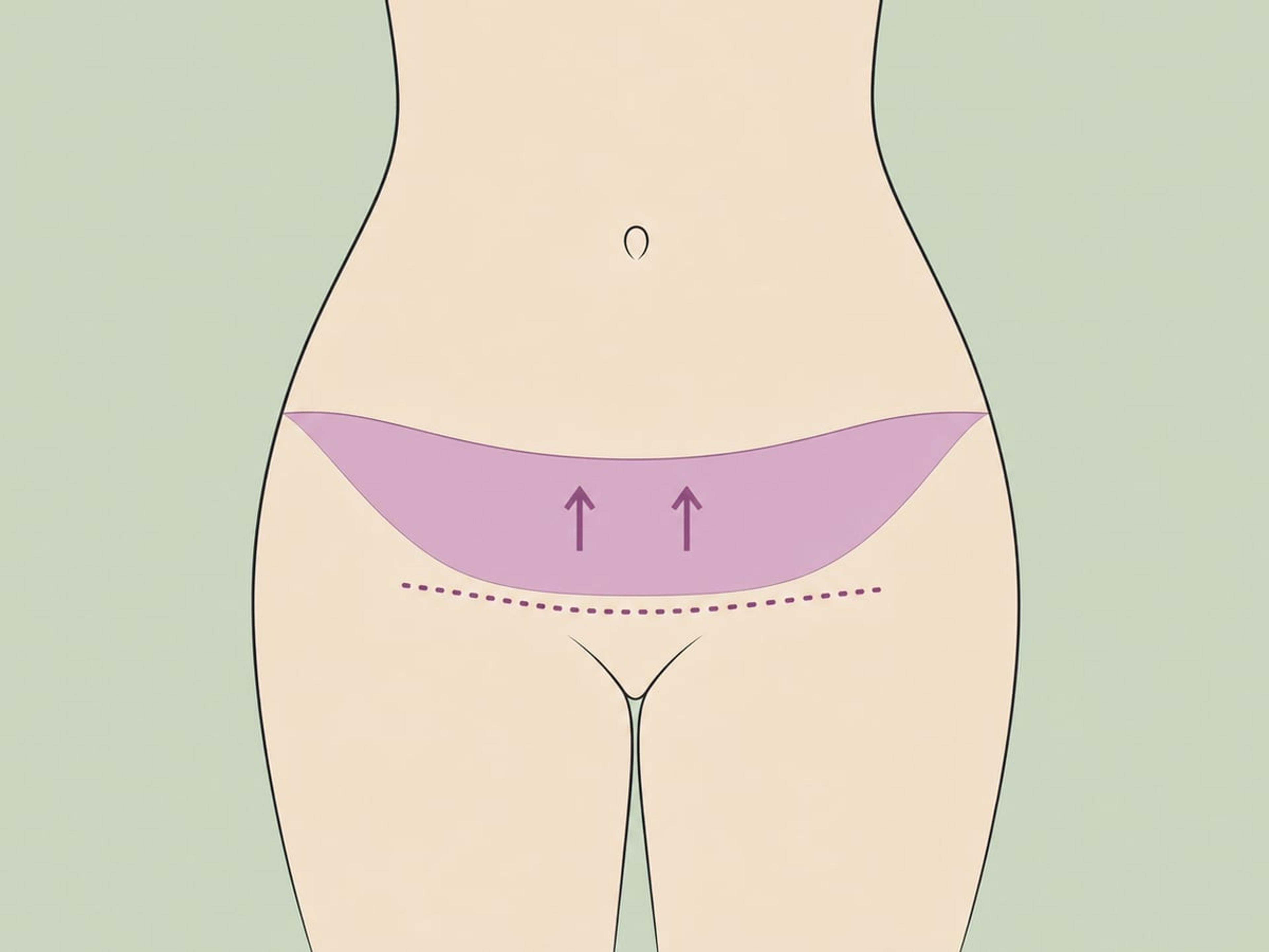 Mini-Bauchdeckenstraffung — illustration
