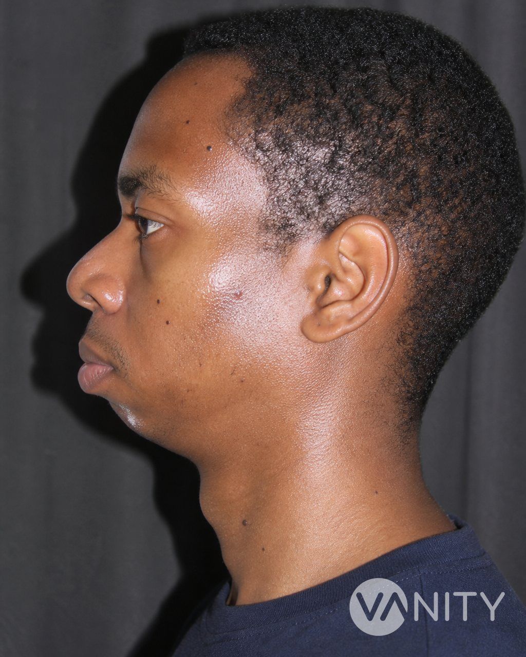 Before Jawline implant — illustrative, not a real patient