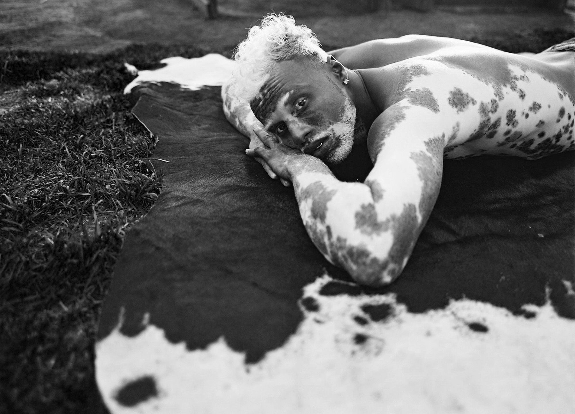 A man with vitiligo, a skin condition that causes white patches, is lying on a cowhide rug, wearing a pair of shorts and a necklace.