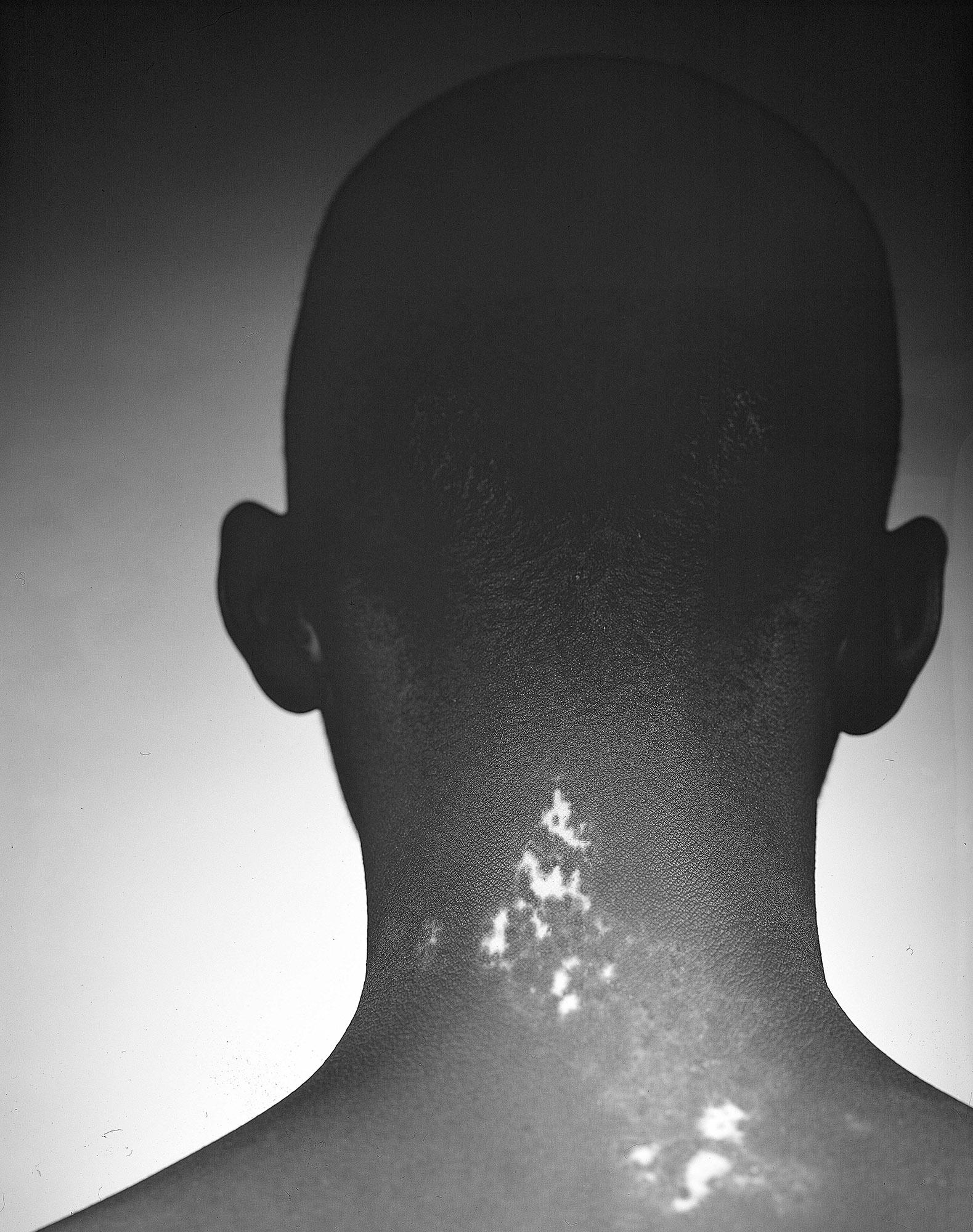 A close-up of the back of a man's head, with a large, white, irregularly-shaped patch of skin on the back of his neck.