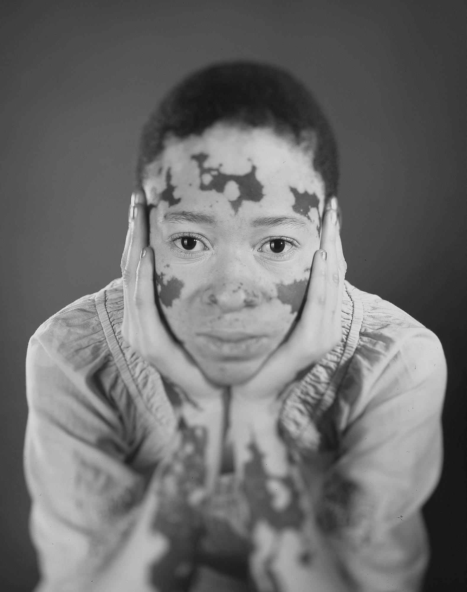 A young boy with vitiligo, a skin condition that causes white patches, is looking directly at the camera with a serious expression, wearing a white shirt.