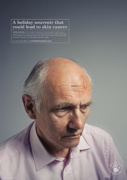 A man with a large, red, and slightly raised skin lesion on his forehead, wearing a white shirt and a serious expression.