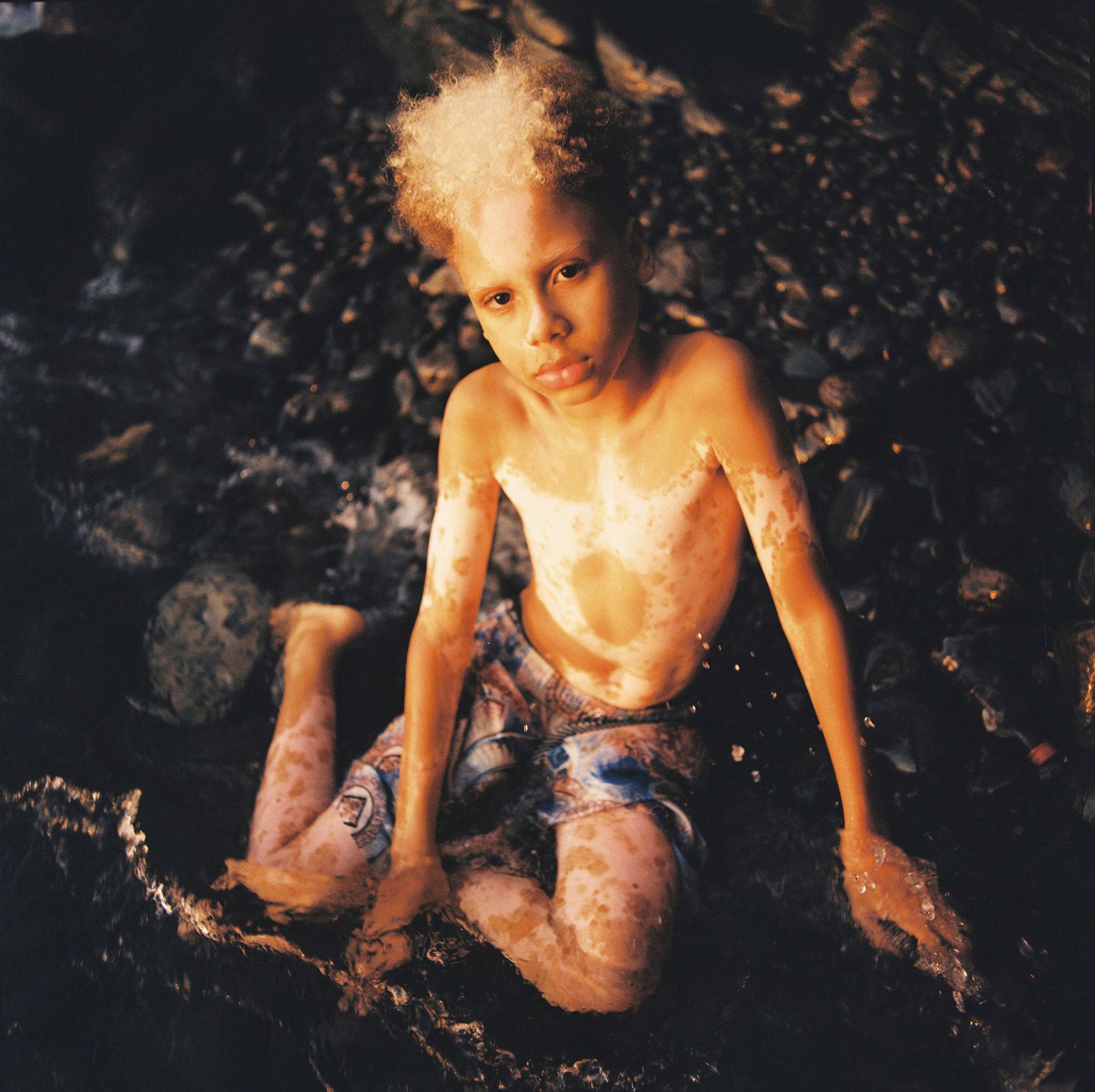 A young boy with vitiligo, wearing a pair of shorts, sitting on a rocky beach, surrounded by water.