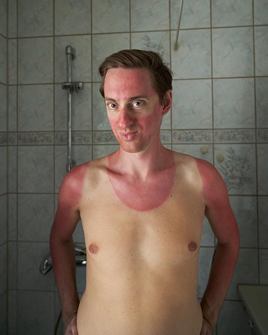A man with a severe sunburn on his chest and shoulders, standing in a bathroom with a shower in the background.