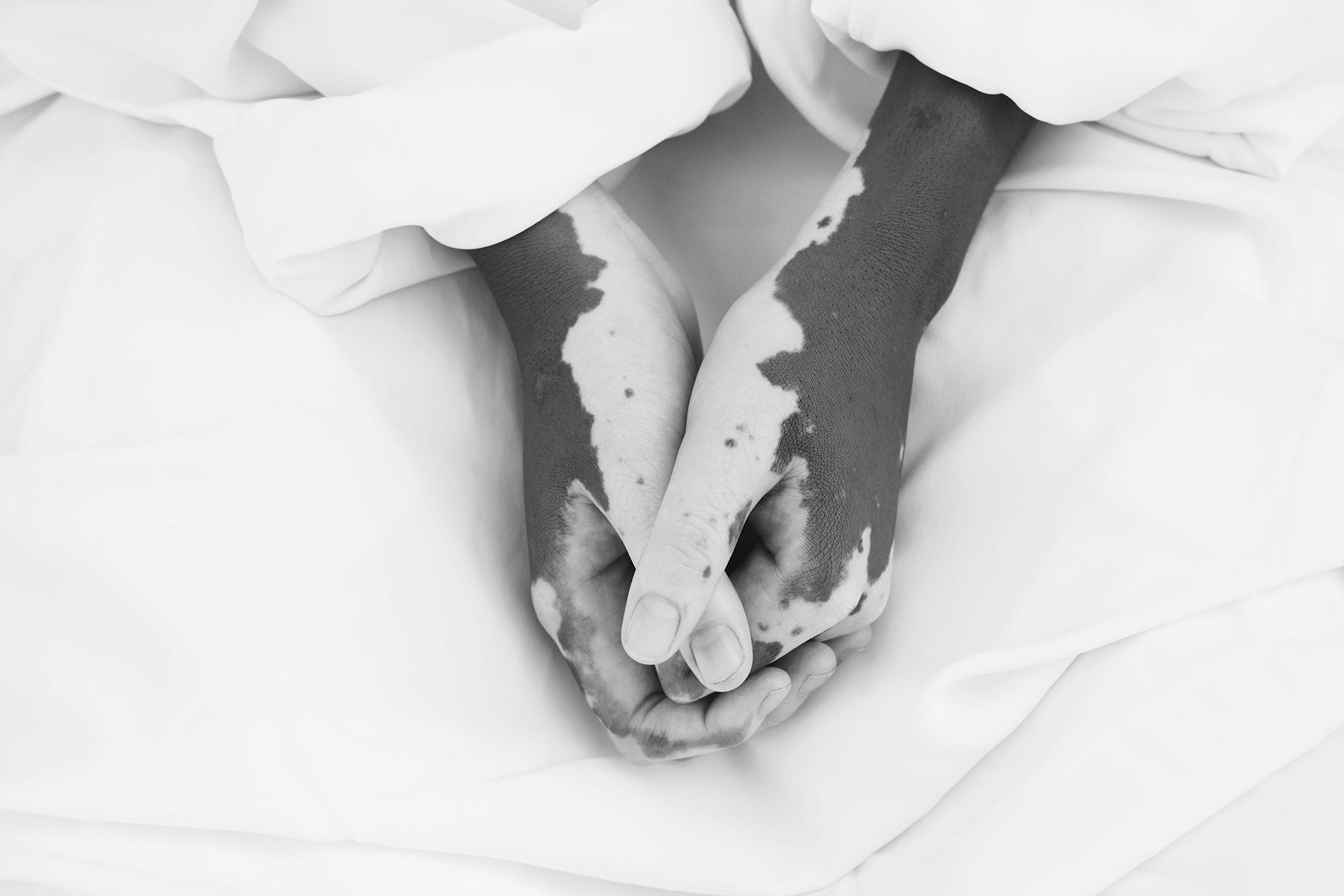 Two people hold hands, showing skin with patches of depigmentation.