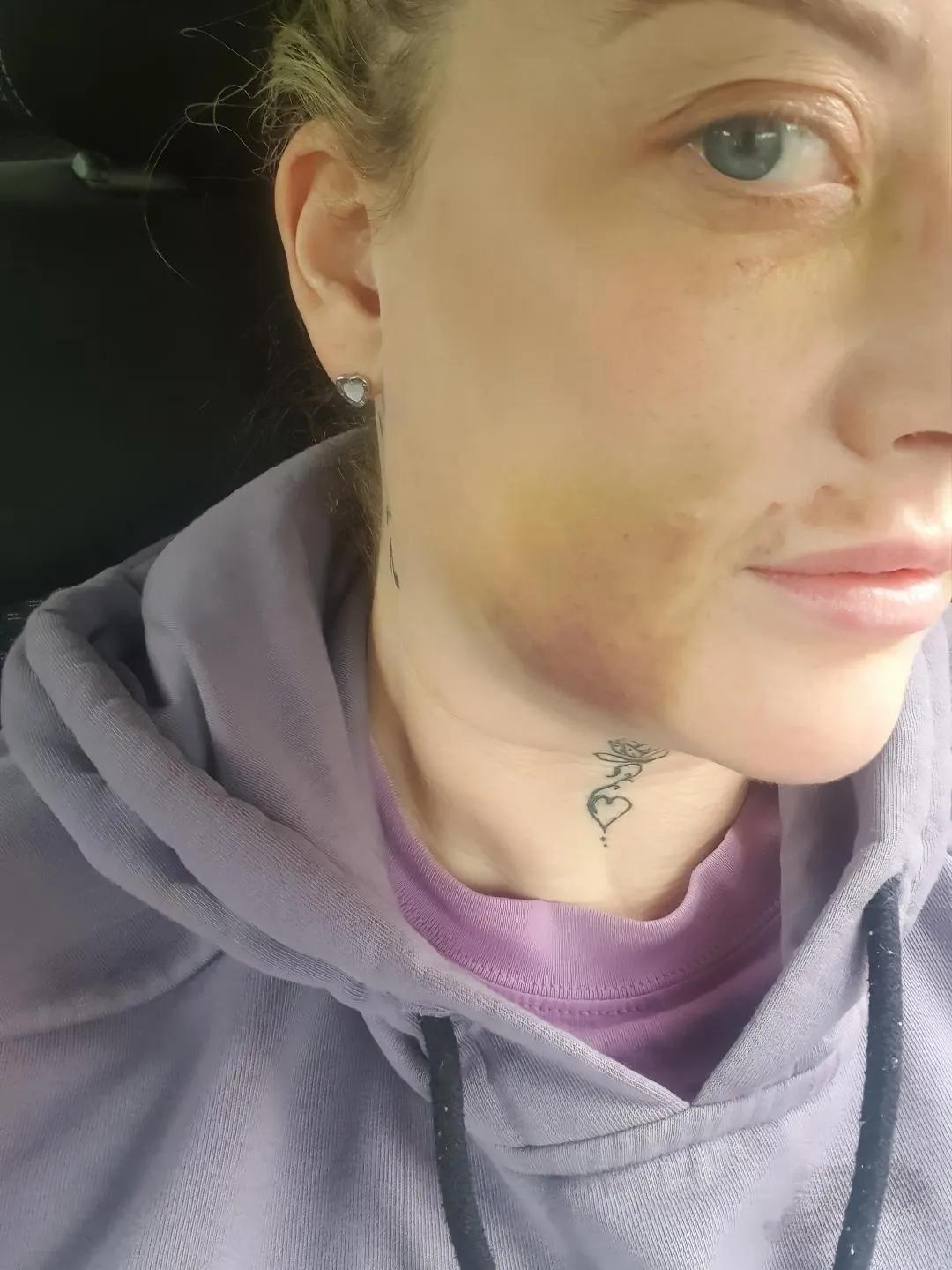 Woman with bruising on her cheek wearing a grey hoodie