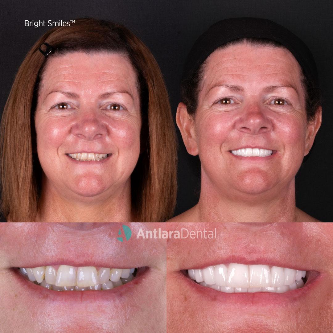 Turkey teeth before and after case