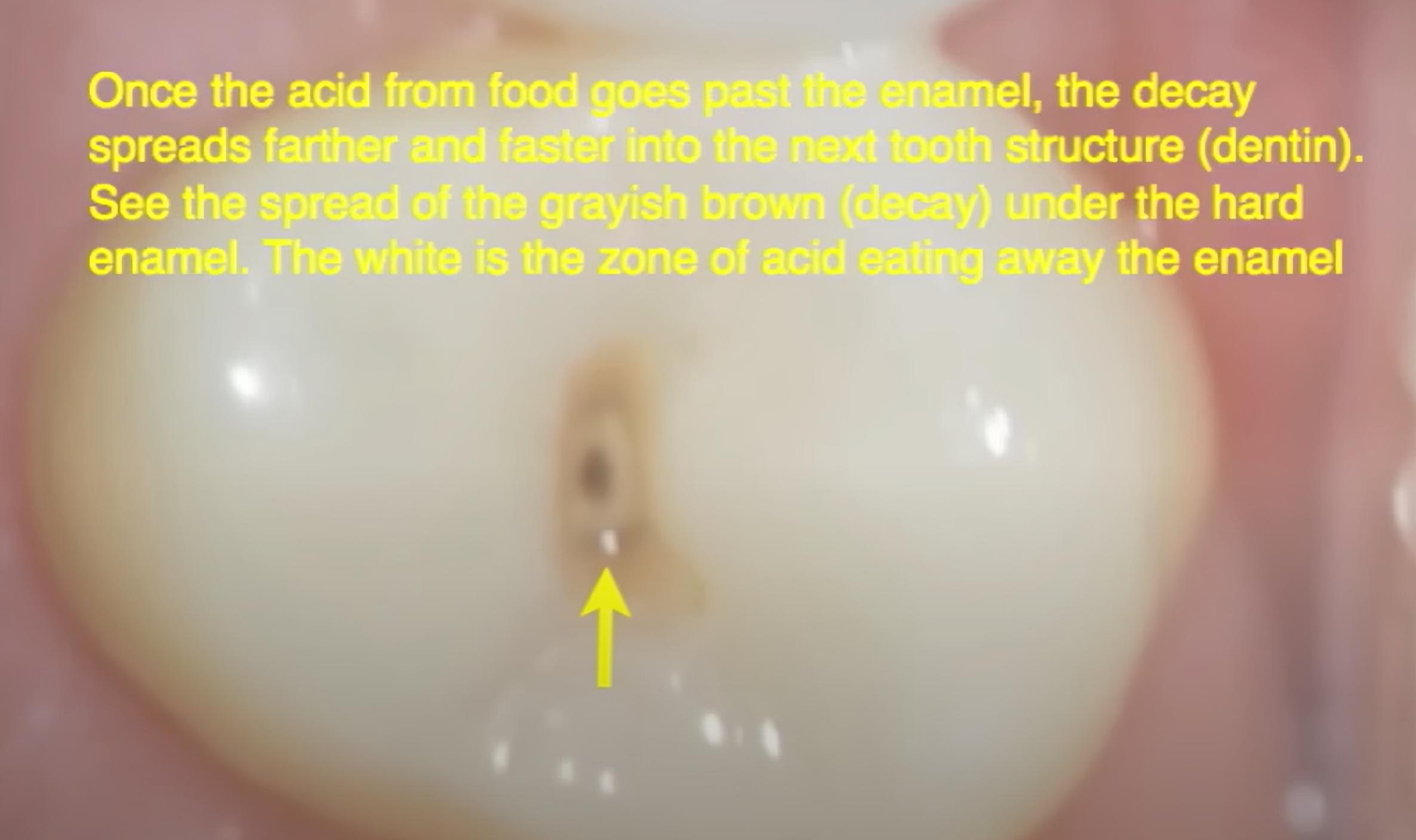 What is a Black Dot on Tooth?