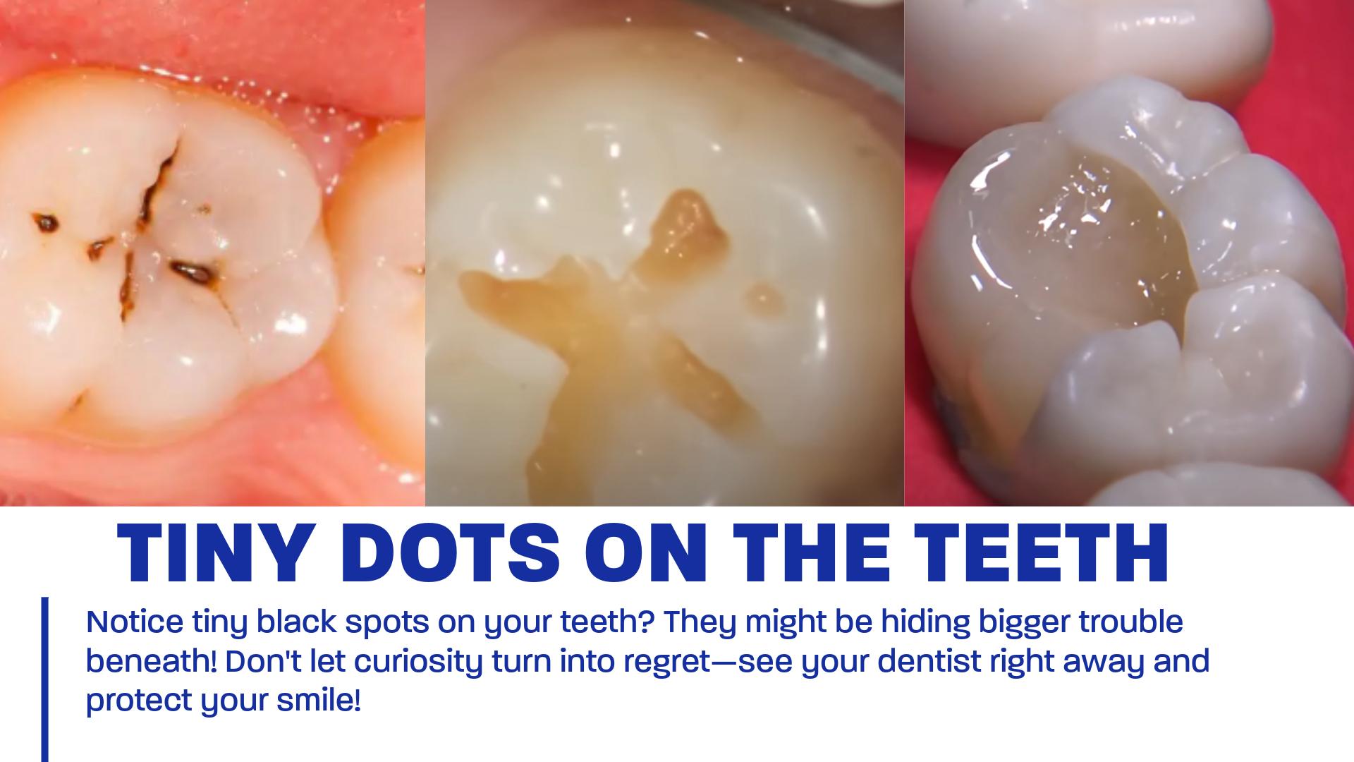 Black Dot on Tooth