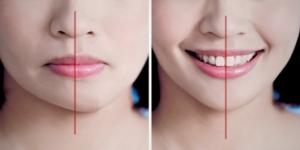 Two faces with a red line marking the dental midline