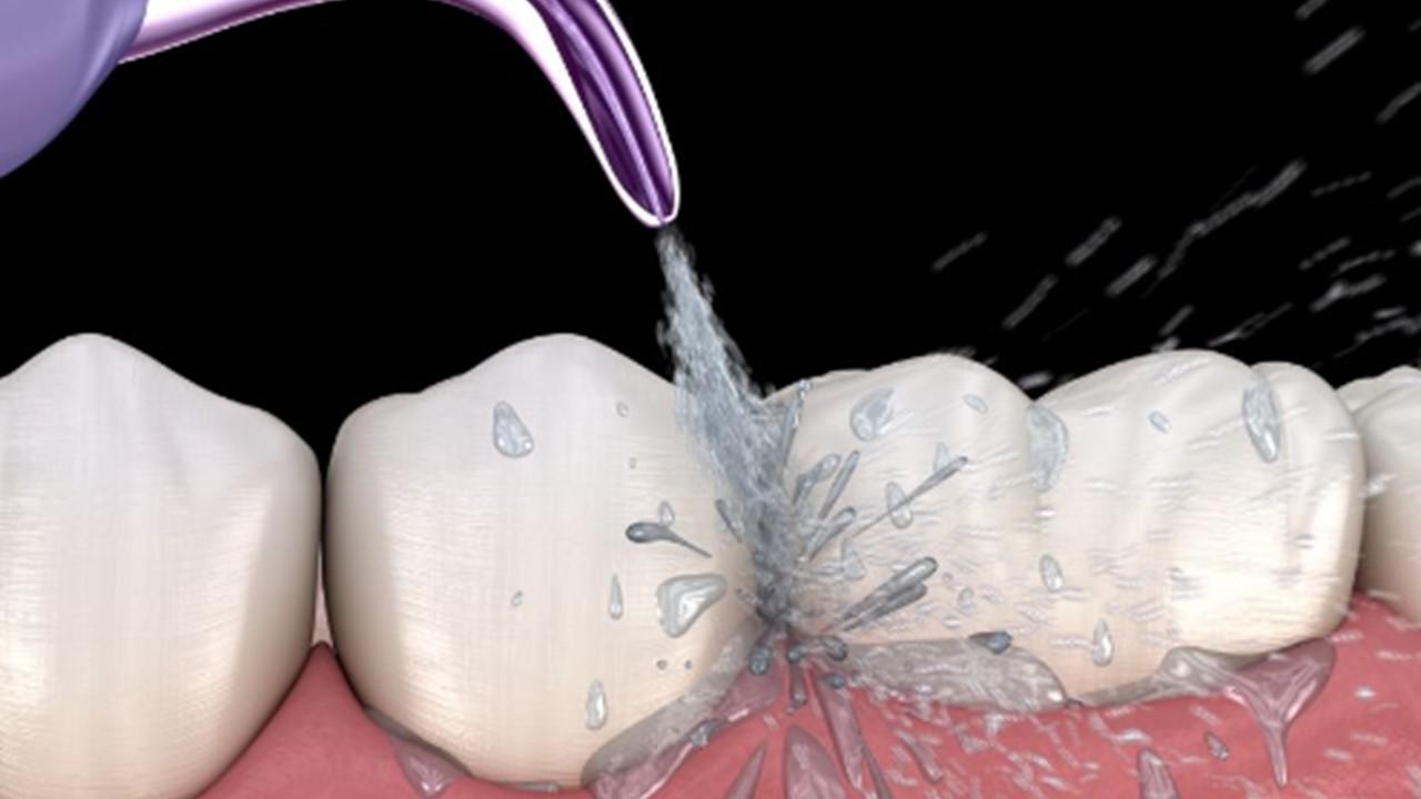 3D illustration of a jet cleaning between teeth at the gum line