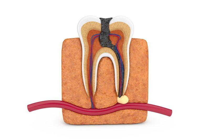 Cross-section of a tooth with decay reaching an abscess at the root tip