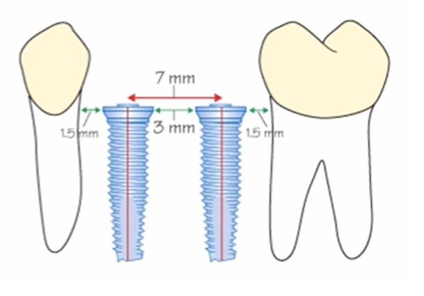 Diagram of two implants between teeth with spacing in millimetres