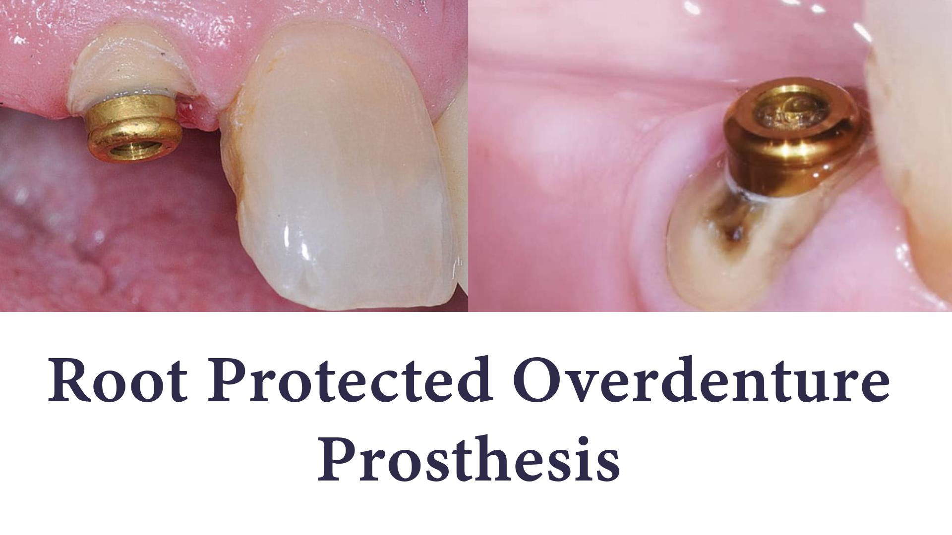 Metal attachments on tooth roots for an overdenture