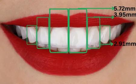 Smile with boxes marking tooth width measurements