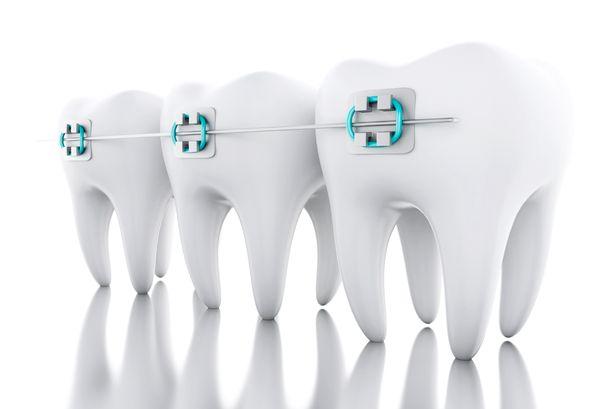 3D render of teeth fitted with braces and wire