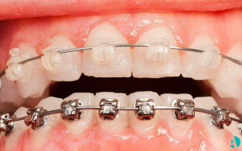 Upper teeth with clear brackets above lower teeth with metal brackets