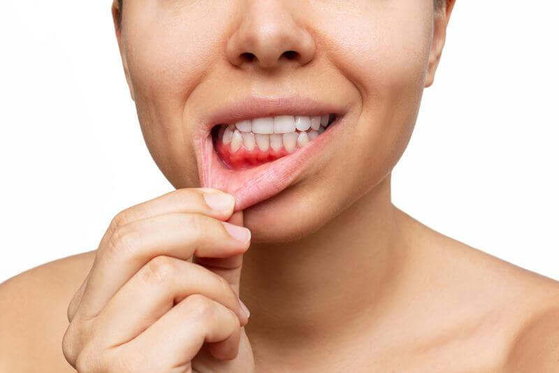 A person pulling down their lower lip to show the gums around the front teeth
