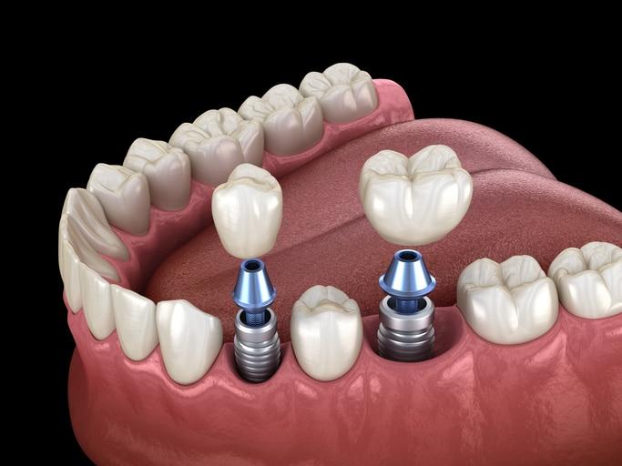 Two standard implants with abutments and crowns