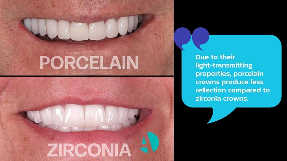 Two smiles with porcelain and zirconia crowns and a caption on light reflection