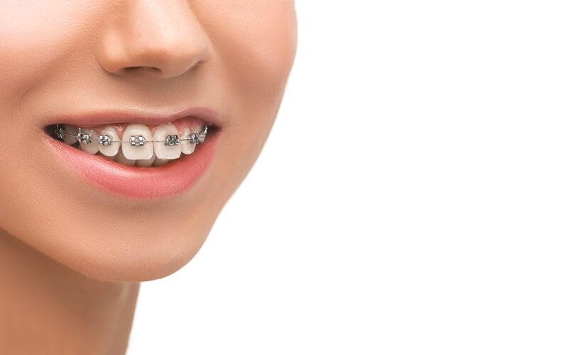 Smile with metal braces