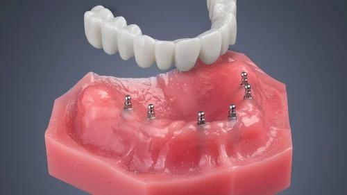 Lower denture above four mini implants in the gum