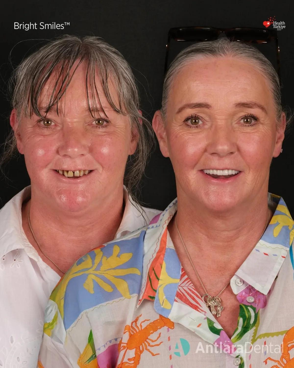 All-on-4 dental implants before and after portrait, patient one