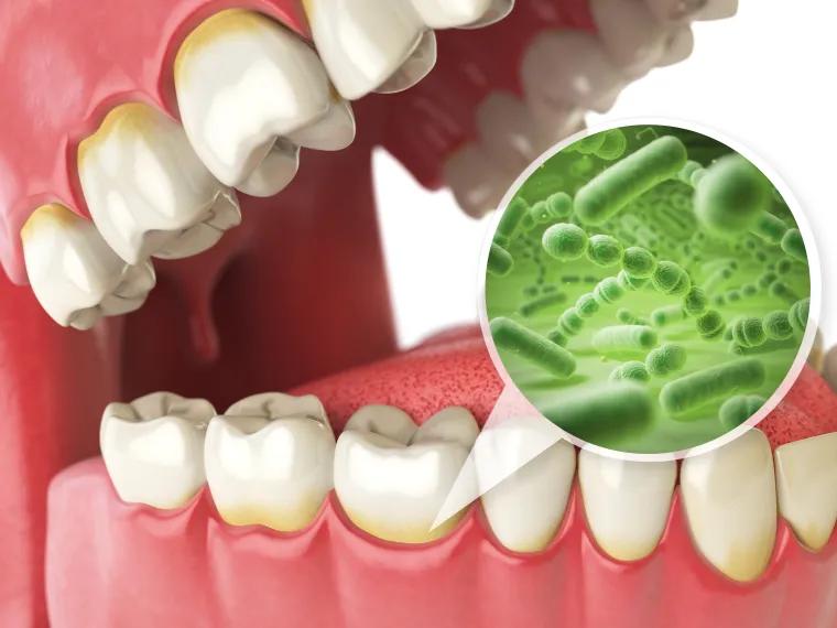 Jaw model with a magnified view of bacteria on teeth