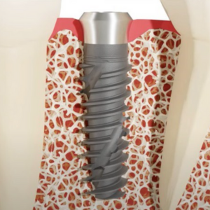 Cutaway of an implant placed in jawbone