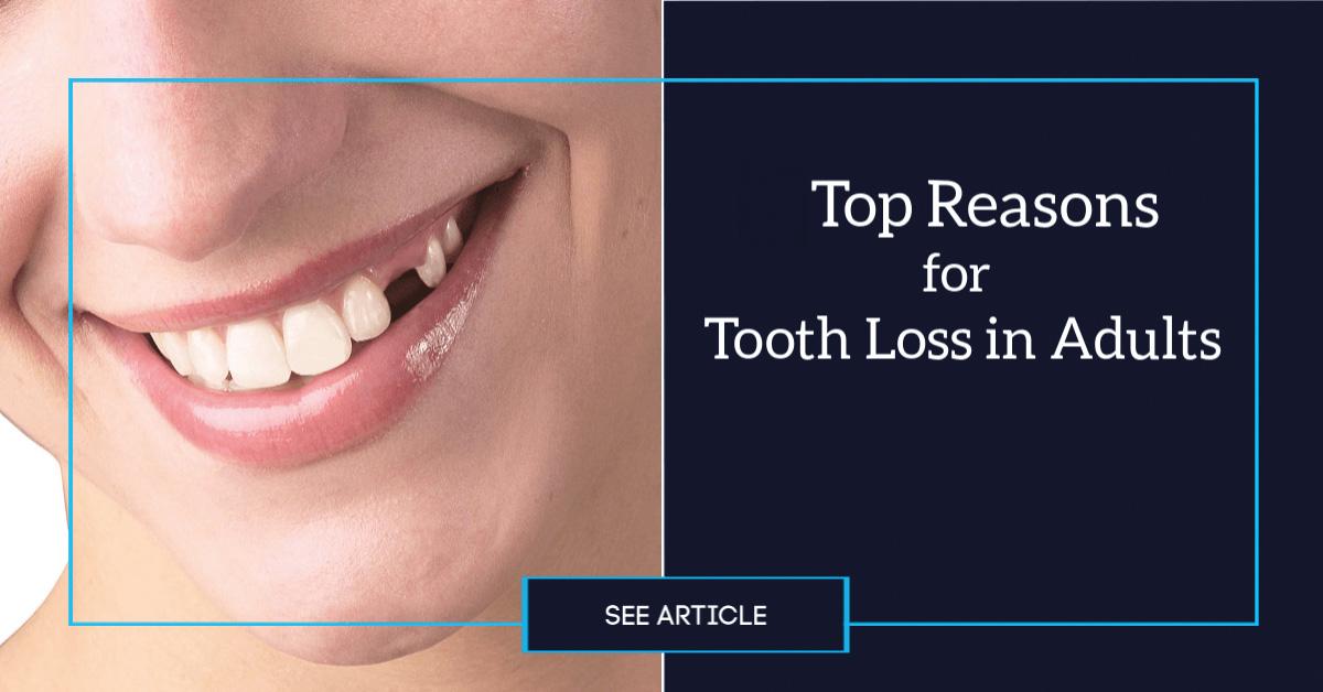 Close-up of a smile with one missing upper tooth