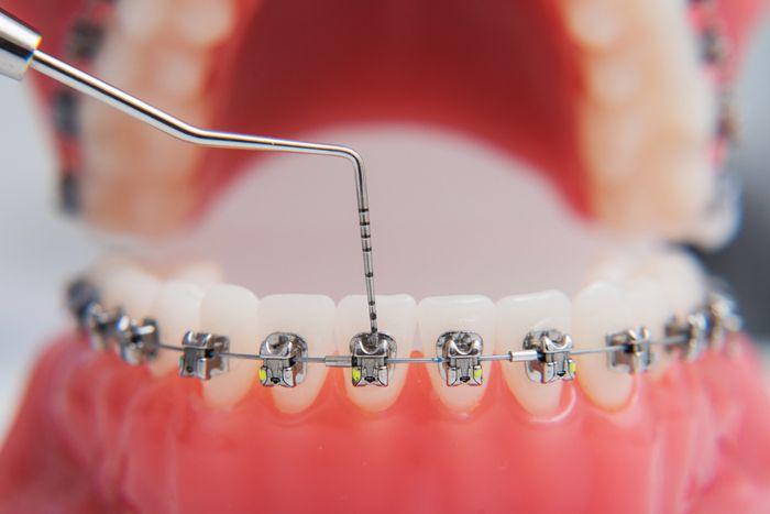 Model jaw with metal brackets and wire touched by a dental probe