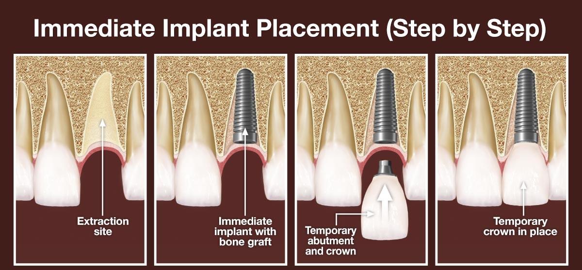 Four-step diagram of an immediate implant with a temporary crown