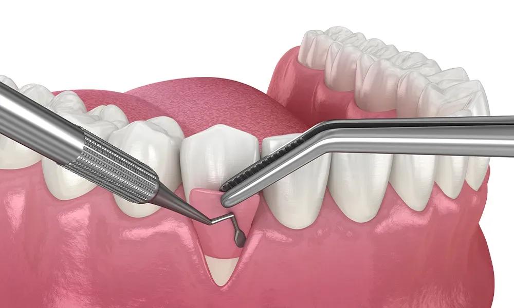 3D illustration of a gum flap lifted with two instruments