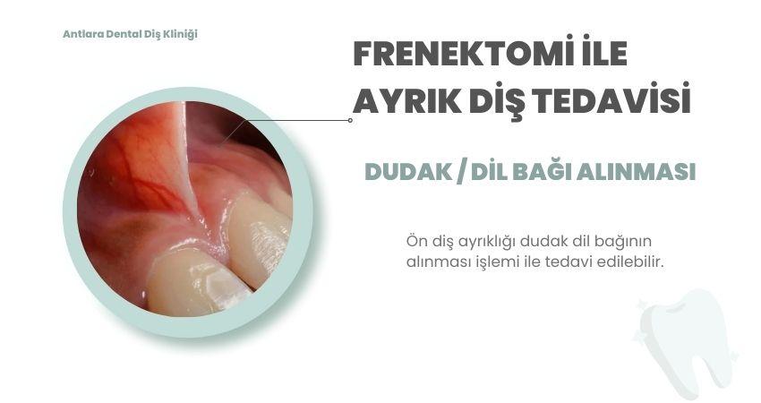 Dudak bağı (frenektomi) bölgesinin klinik yakın çekimi