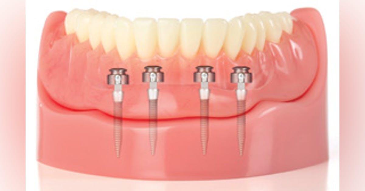 Lower jaw model with four mini implants