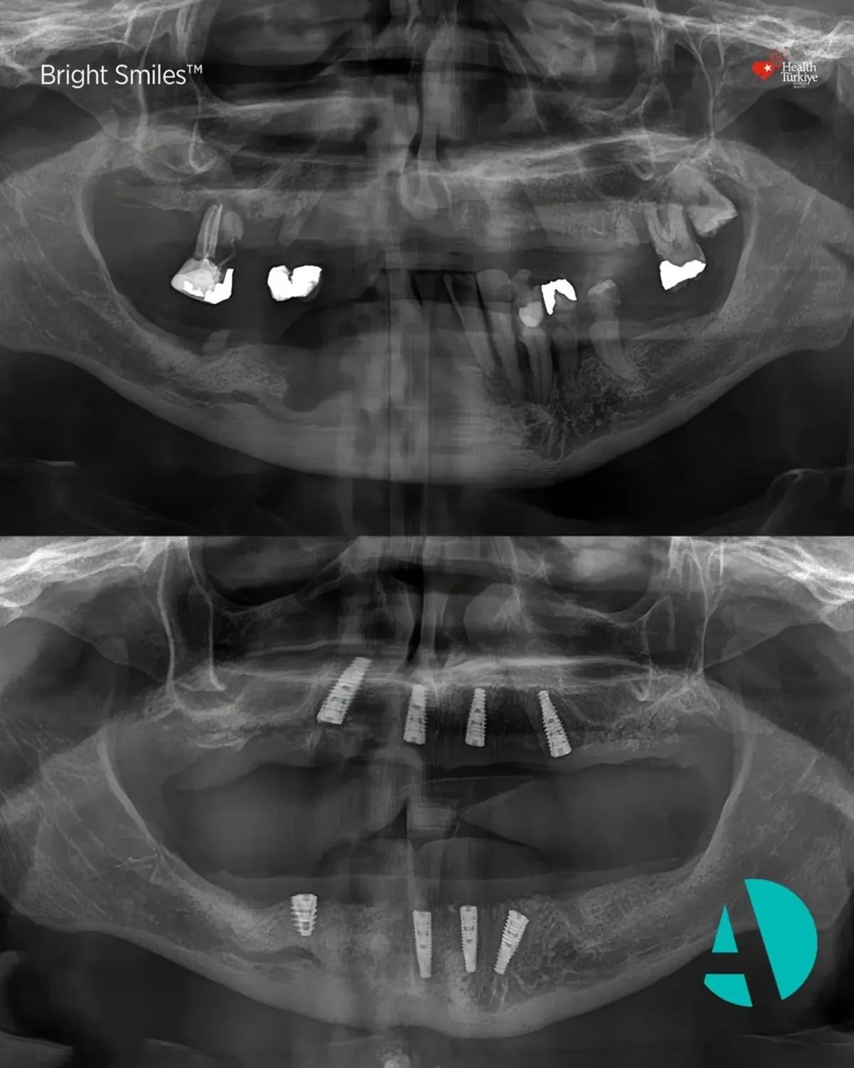 Panoramic x-ray before and after All-on-4 dental implants, patient two