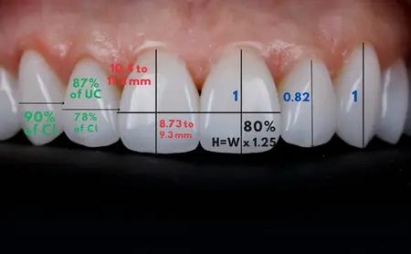 Front teeth with length and width proportion measurements