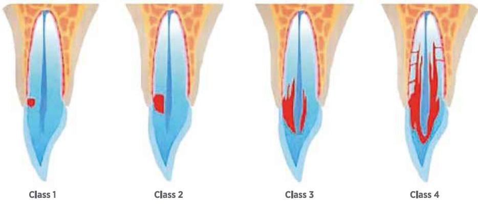 Diagram of four classes of root resorption in a tooth
