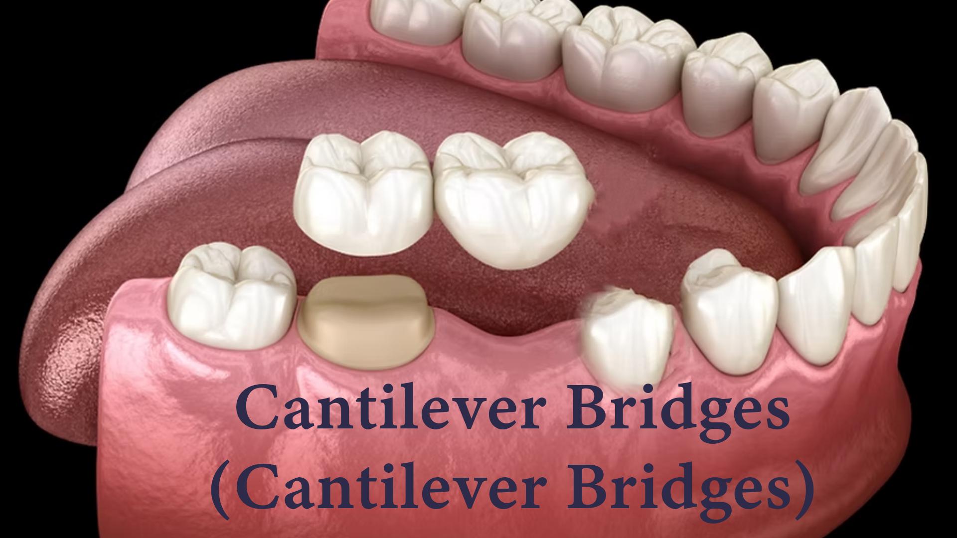 3D illustration of a cantilever bridge on lower molars