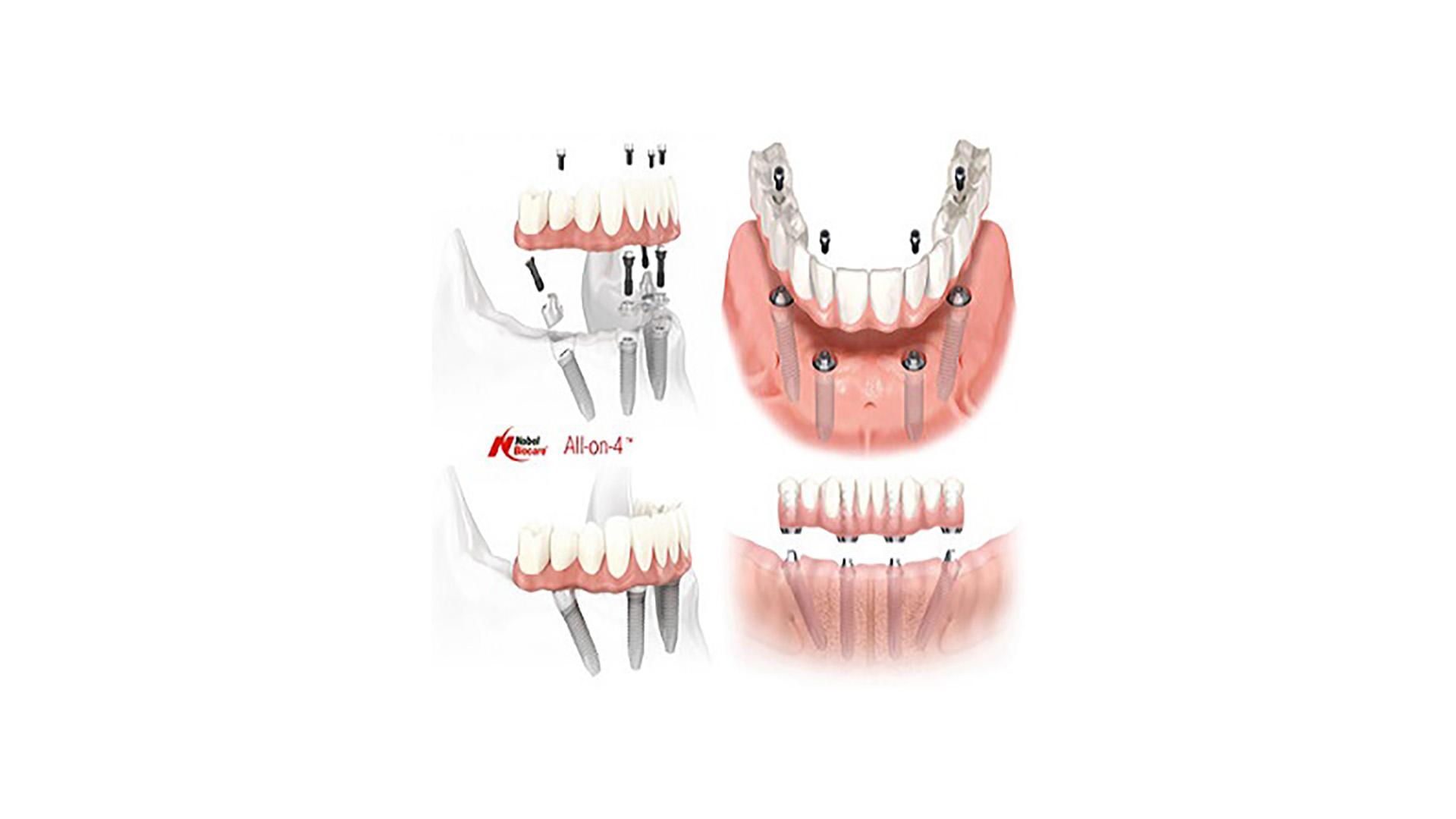 Illustration of an All-on-4 lower jaw with four implants and a fixed bridge