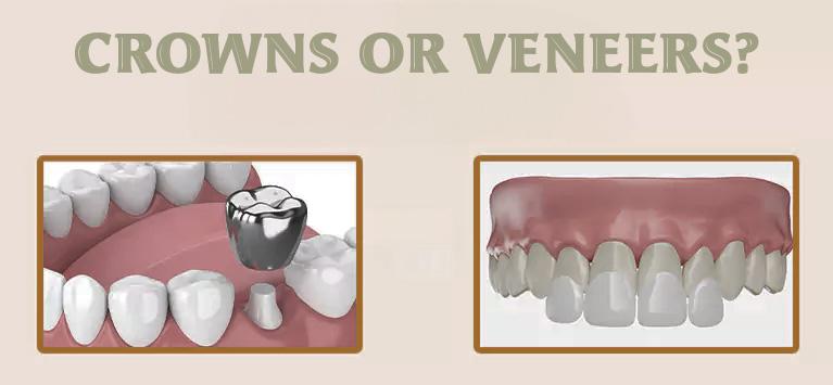 Crowns or veneers