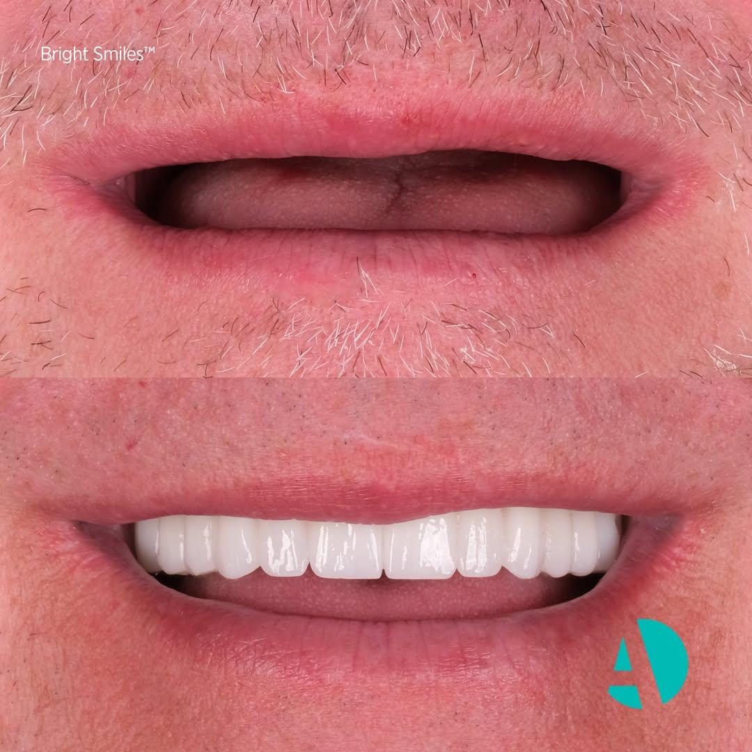 All on 6 dental implants before and after All on 6 dental implants before and after